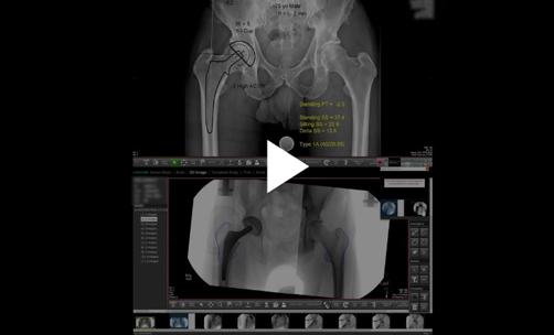 Direct Anterior Total Hip Arthroplasty Using Radlink